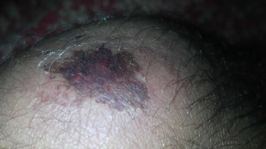Lawyer Ronnie Marks posted on Facebook Monday night this photo of his bruised knee.