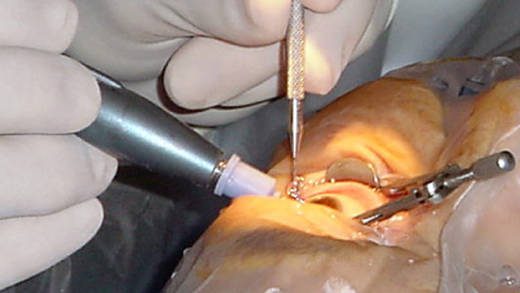 Cataract surgery