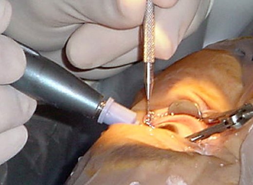 Cataract surgery