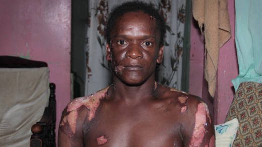 The virtual complainant, Cuthbert "mafia" Victory sustained burns to his face, chest, shoulders and arms. (iWN file photo)