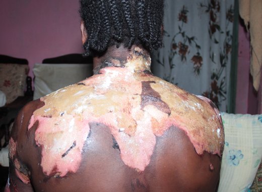 Cuthbert "Mafia" Victory sustained burns about his body in the April 9, 2016 attack. (iWN file photo)