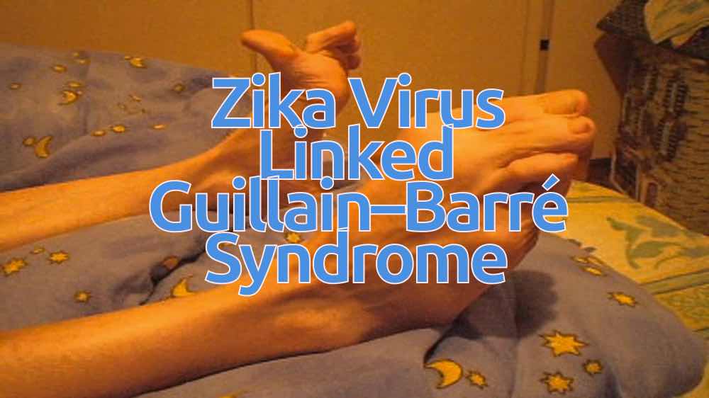 scientists discovered guillain barre syndrome linked zika virus