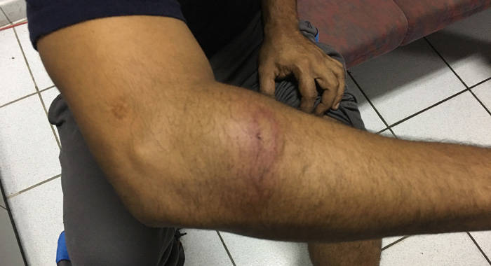 Pablo Malave shows iWitness News and injury to his arm inflicted when he was reportedly beaten. (IWN photo)