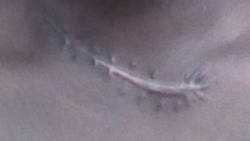 Idinga Bobb has been left with this nasty scar to her neck as a result of the attack.