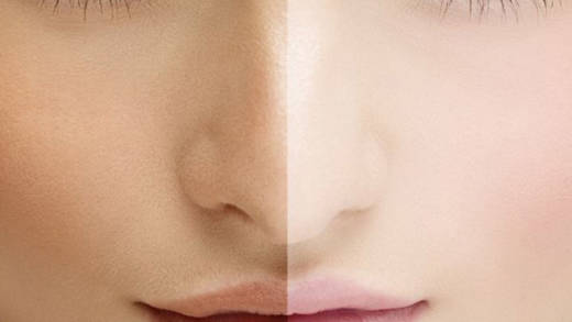 skin bleaching