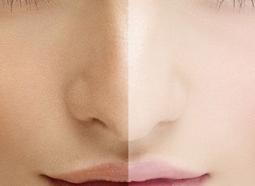 skin bleaching