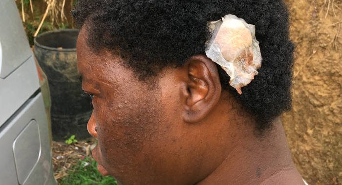 Letteen suffered a cut to the head during the cutlass attack. (iWN photo)