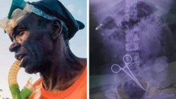 Arnott Hope, left died at the Milton Cato Memorial Hospital after a surgical tool was reportedly stitched up in his abdomen, purportedly shown at right.
