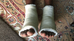 Roydel Solomon's leg are in a cast after being shot by police. (iWN photo)
