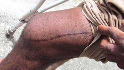 Teron "Frenchman" Baptiste shows the scar from the surgery to his leg. (iWN photo)