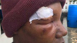 Zamicha Haywood's right eye remained swollen shut three days after the beating. (iWN photo)