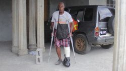 Cornelius John at his home with his injured leg in a cast on May 5, 2021. (iWN photo)