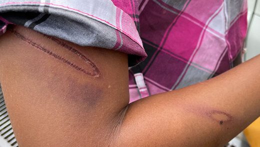 Clothilda Durrant shows  marks on her arm from the beating. (iWN photo)