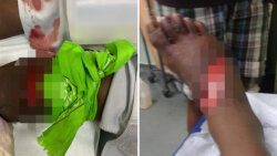 Two children were left with serious injuries at the playground in Barrouallie last week. 