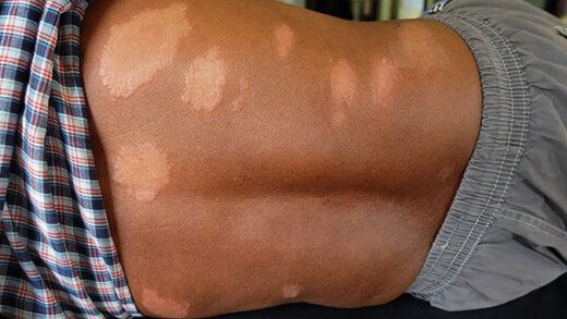 An internet photo of a person who has leprosy. 