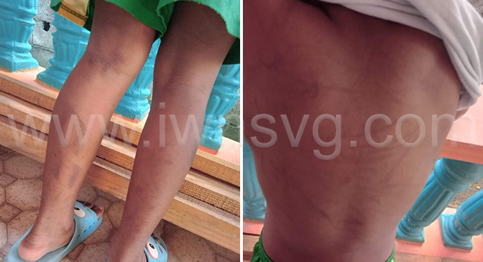 Photo of the child after the alleged beating.