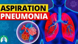 aspiration pneumonia