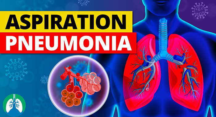 aspiration pneumonia